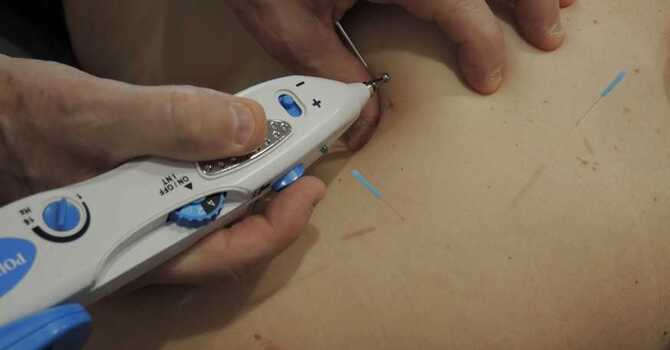 Sports Medicine Acupuncture ®